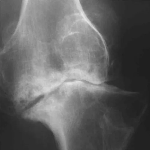 Osteoarthritis of knee – illustration 8