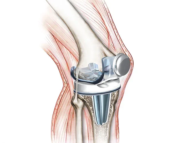 Knee Sports Injury