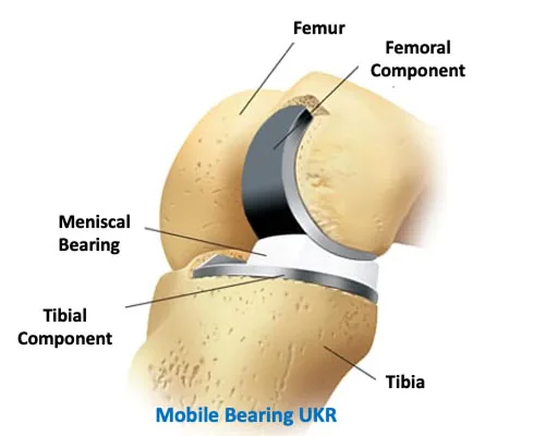 Knee UKR – illustration 3