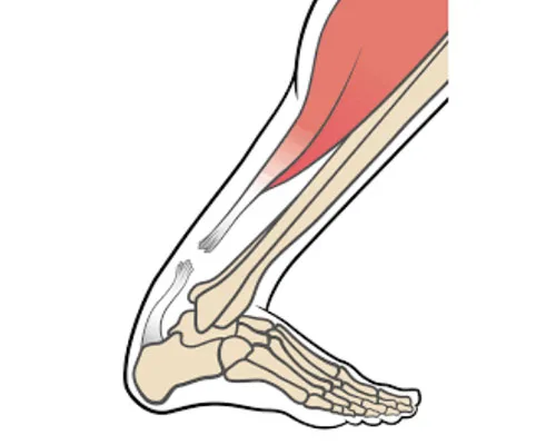 Achilles Tendon Injury
