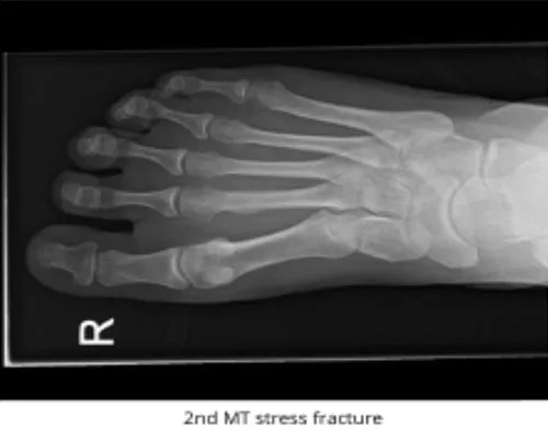 Stress fracture