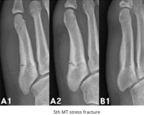 Stress fracture – illustration 2