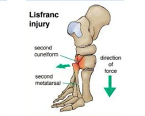 Lisfracs Injury