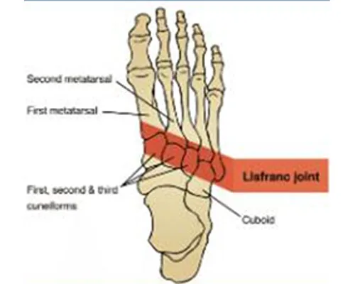Lisfracs Injury – illustration 2