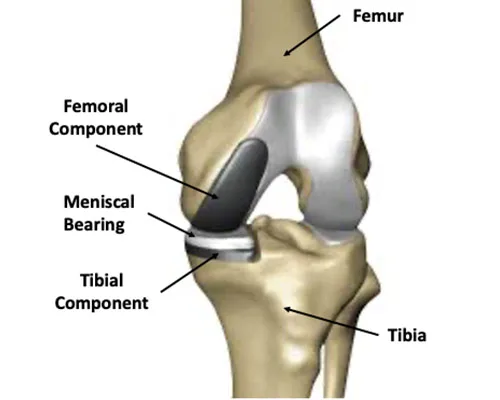 Knee UKR – illustration 2