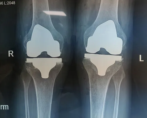 Knee TKR – illustration 3