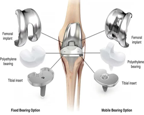 Knee TKR