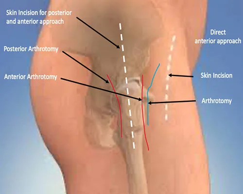 Hips THR – illustration 3