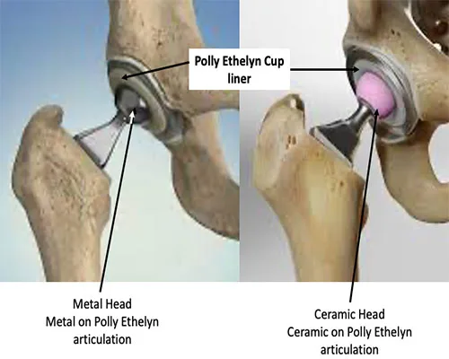 Hips THR – illustration 2