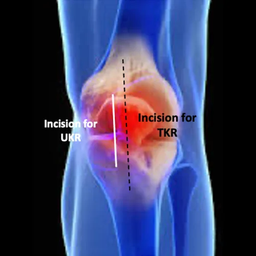 Knee UKR