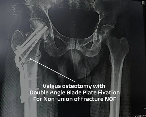Hip Osteotomy – illustration 3