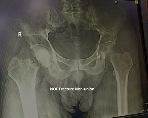 Hip Osteotomy – illustration 4