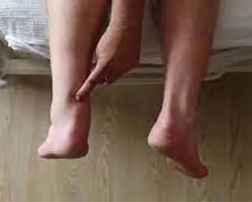 Achilles Tendon Injury – illustration 2
