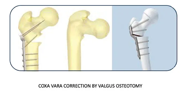 Hip Osteotomy – illustration 2