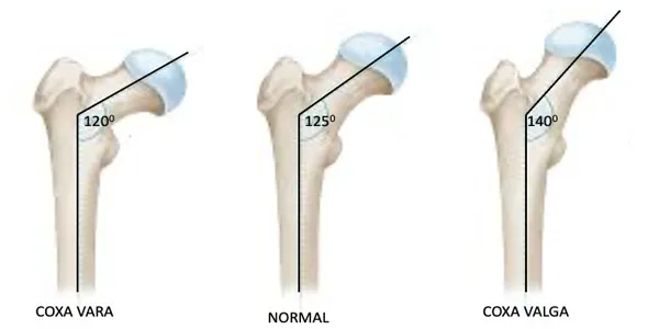 Hip Osteotomy