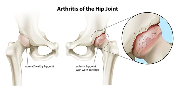 Hip Osteoarthritis