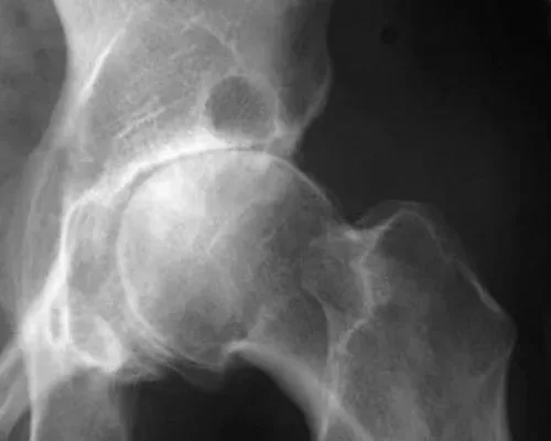 Hip Osteoarthritis – illustration 3
