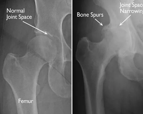 Hip Osteoarthritis – illustration 2
