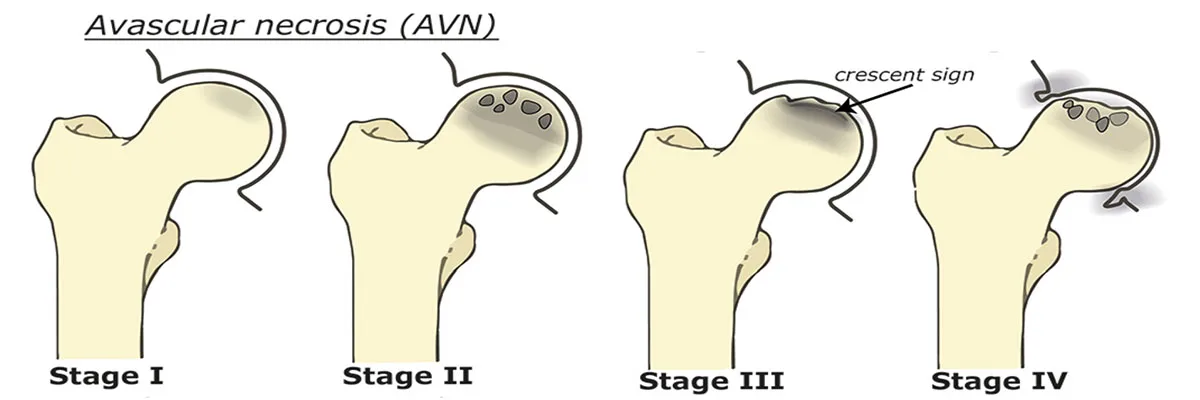 AVN – illustration 2