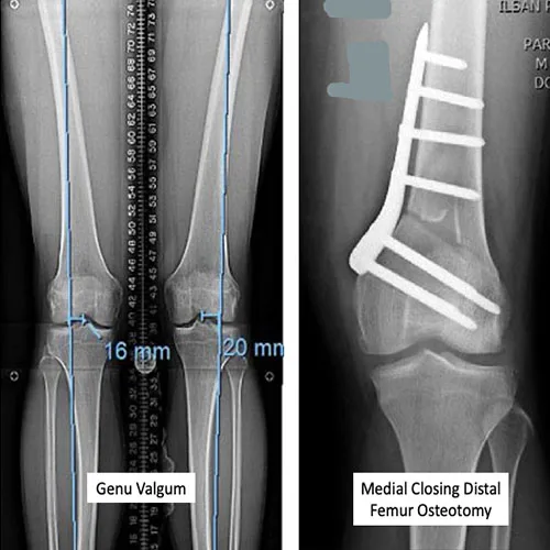 Knee Osteotomy – illustration 2