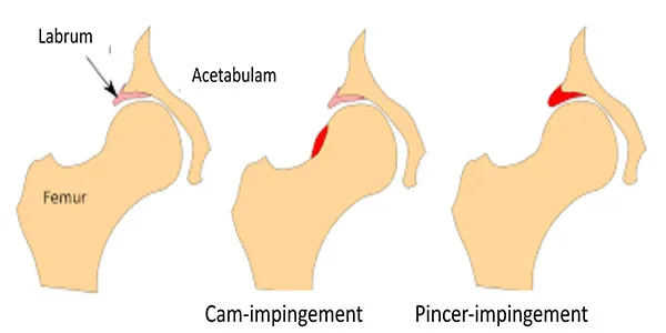 Impingement