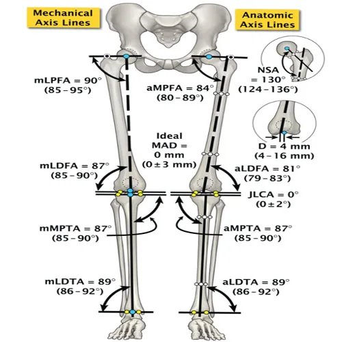 Knee Osteotomy