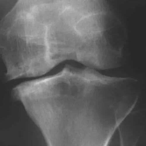 Osteoarthritis of knee – illustration 7