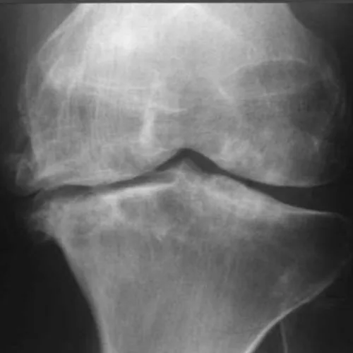 Osteoarthritis of knee – illustration 6