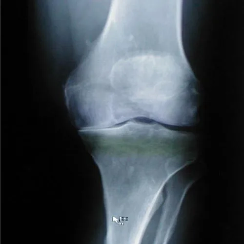 Osteoarthritis of knee – illustration 5