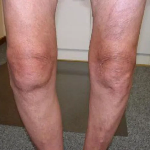 Osteoarthritis of knee – illustration 4