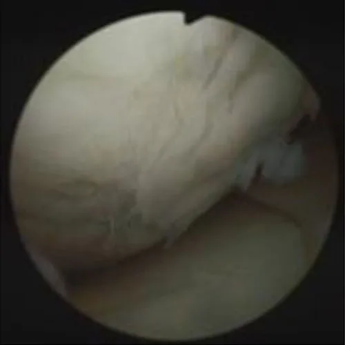 Osteoarthritis of knee – illustration 3