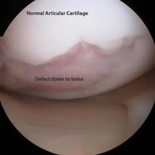 Osteoarthritis of knee – illustration 2