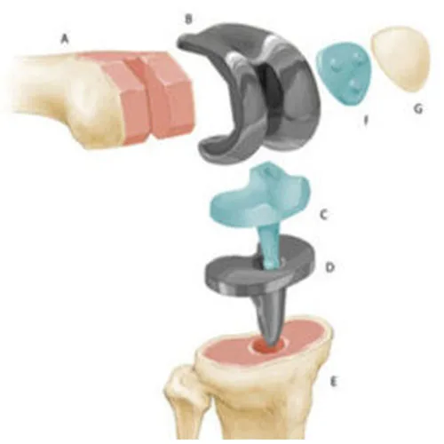 Knee TKR – illustration 2
