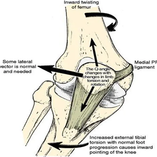 Patellofemoral instability