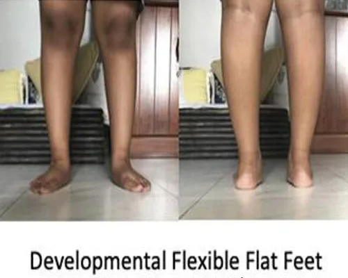 Flat Feet