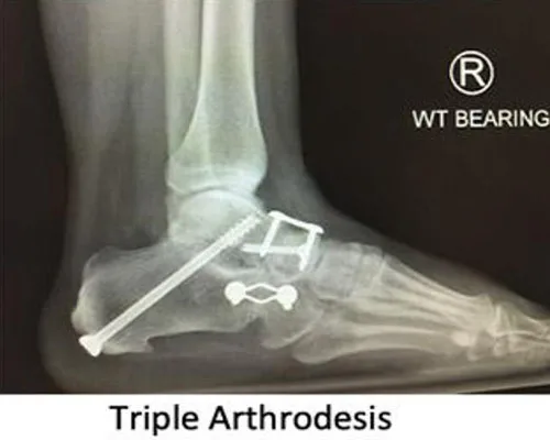 Flat Feet – illustration 6