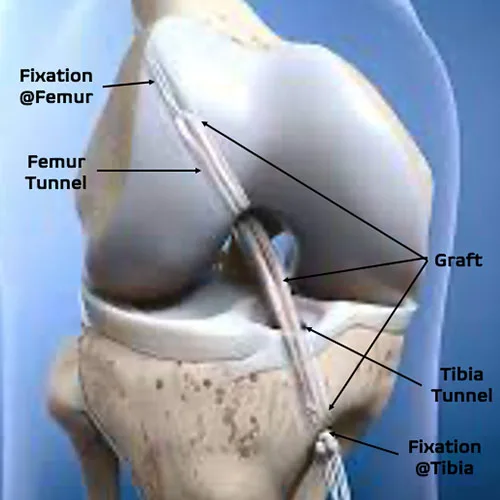 ACL Reconstruction – illustration 2