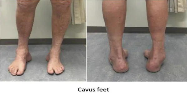High Arch Foot