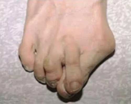Bunion/Hallux Valgus