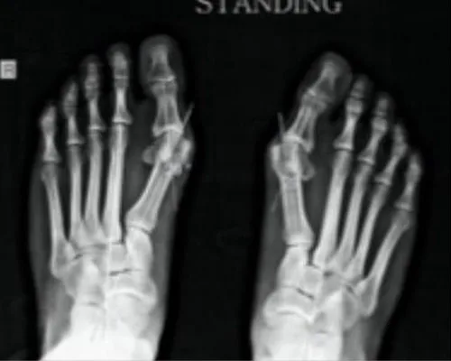 Bunion/Hallux Valgus – illustration 2