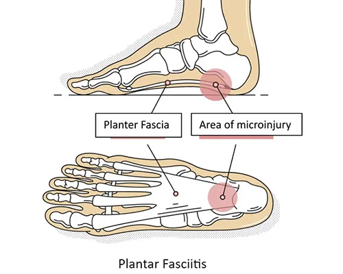 Heel Pain