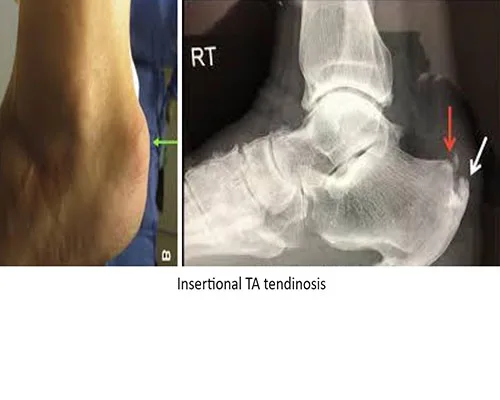 Heel Pain – illustration 2