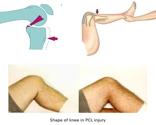 PCL Injuries – illustration 2