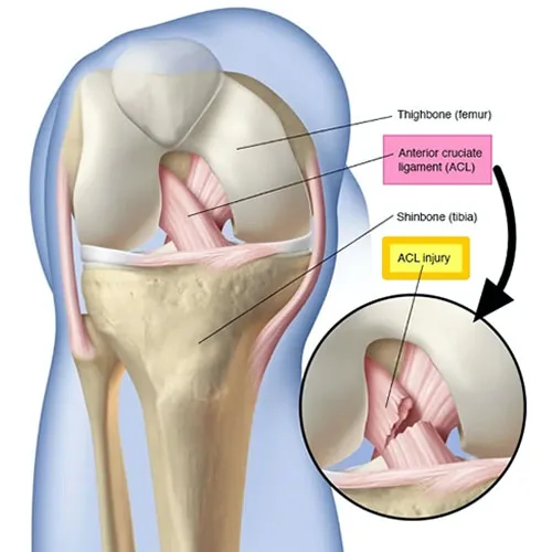 ACL Reconstruction
