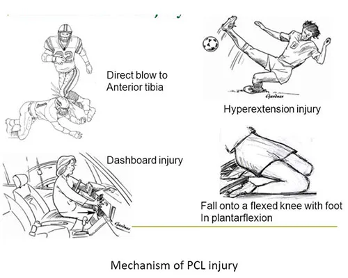 PCL Injuries