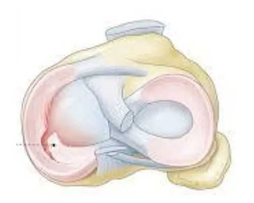 Knee Meniscus Injury – illustration 2