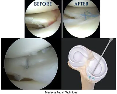 Meniscal Repair